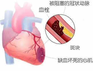 血栓的形成原因及后果，如何預(yù)防血栓導(dǎo)致的疾病