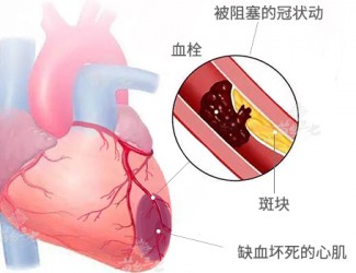 心臟病該怎么辦，且看臨床治療醫(yī)案一則